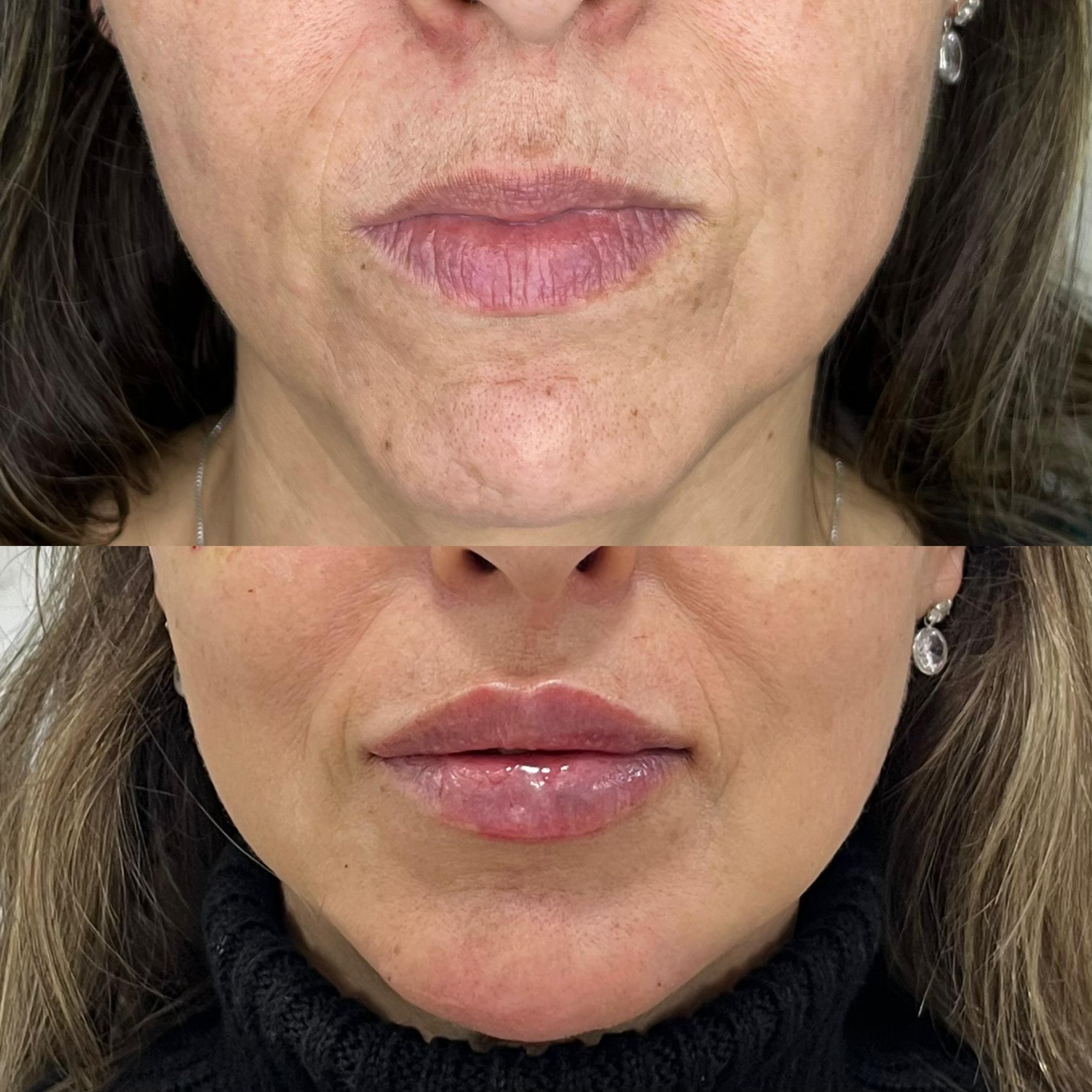 Antes e depois do procedimento Boca de 20 anos