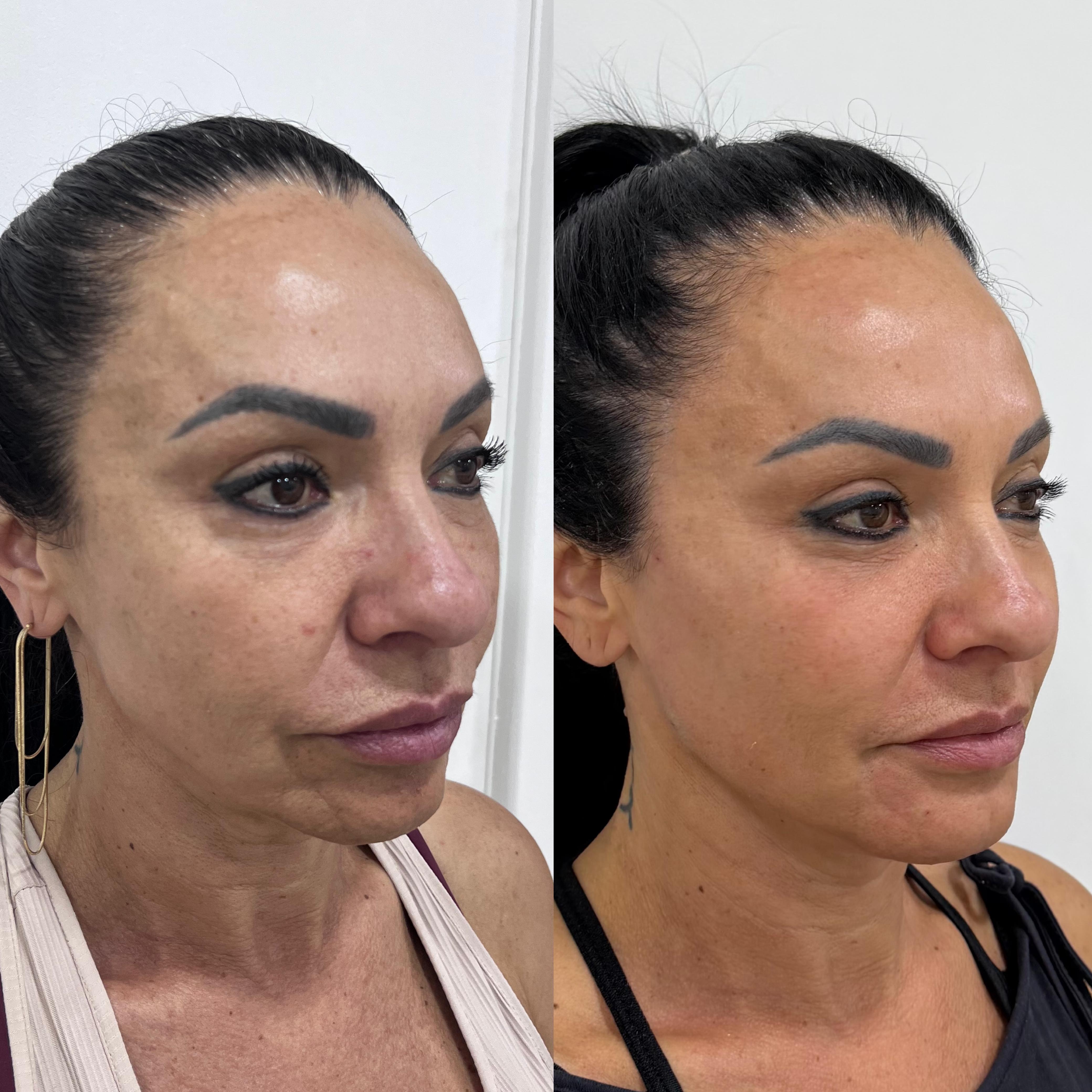 Antes e depois do procedimento Pele Iluminada