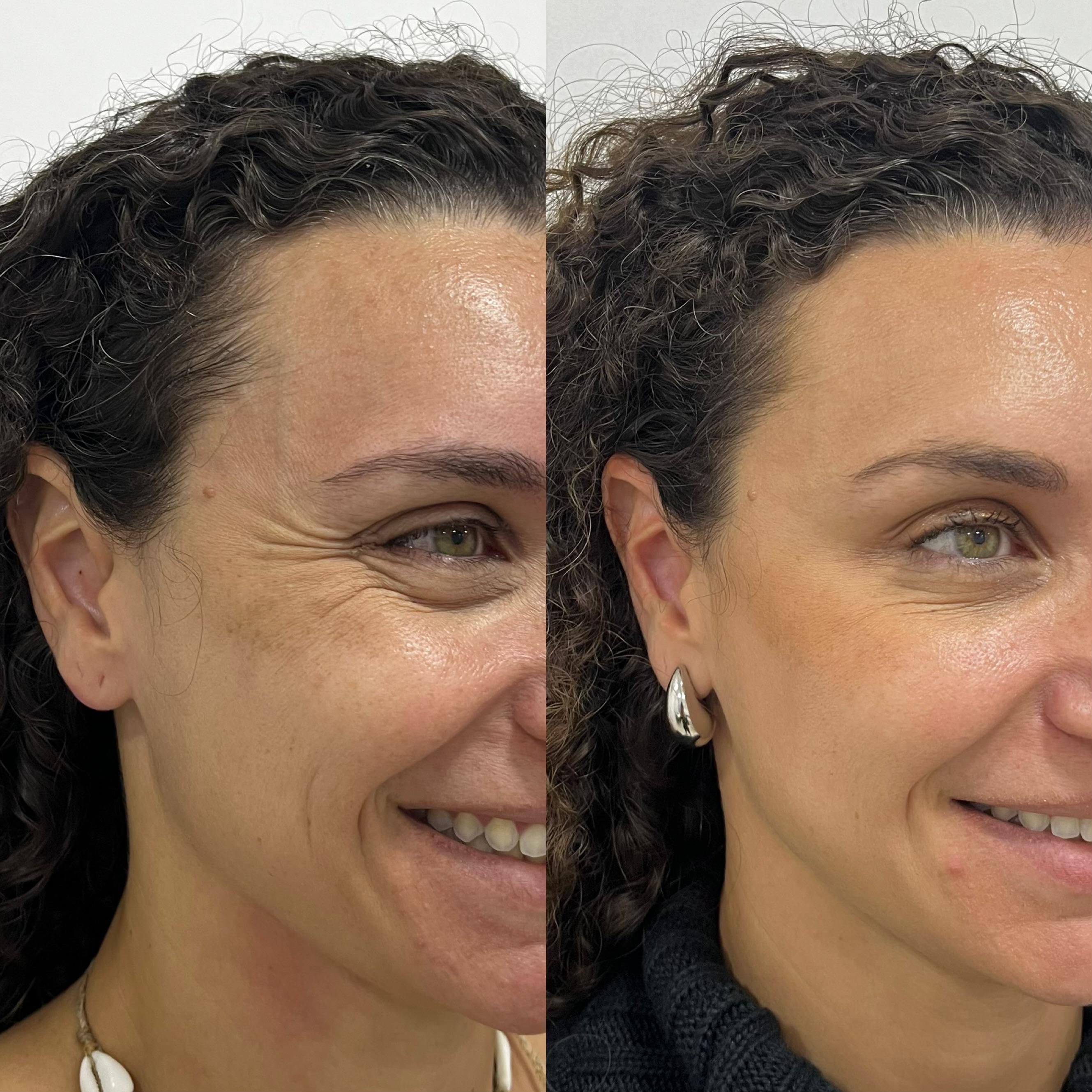Antes e depois do procedimento Xô Pé de Galinha