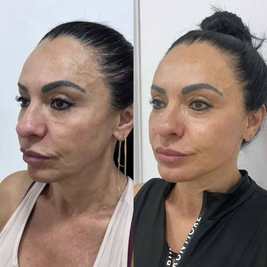 Antes e depois de bioestimulador de colágeno, vista 45 graus — paciente da biomédica Jessica Boza em Curitiba