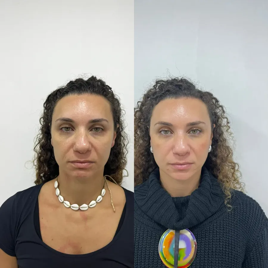 Antes e depois de botox, vista frontal — paciente da biomédica Jessica Boza em Curitiba
