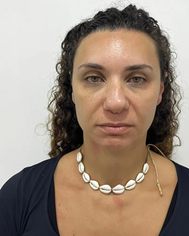 Antes da aplicação de botox, caso 1, vista frontal — paciente da biomédica Jessica Boza em Curitiba