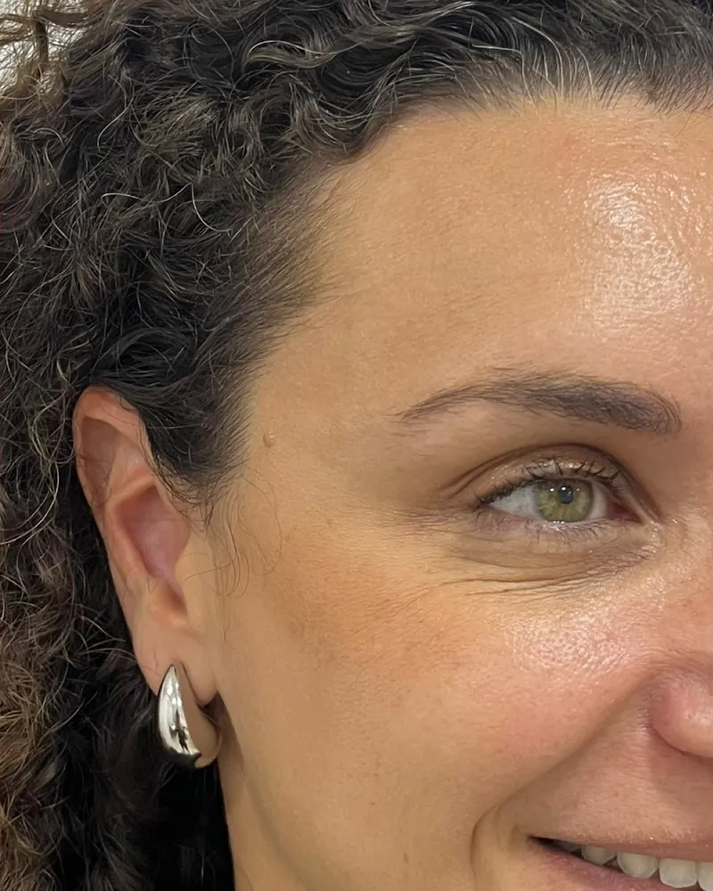 Depois da aplicação de botox, caso 1, região dos pés de galinha — paciente da biomédica Jessica Boza em Curitiba