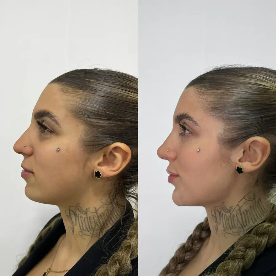 Antes e depois de contorno de mandíbula e mento, vista de perfil — paciente da biomédica Jessica Boza em Curitiba