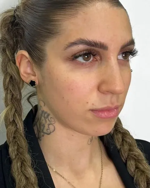 Antes do contorno de mandíbula e mento, caso 1, vista a 45 graus — paciente da biomédica Jessica Boza em Curitiba