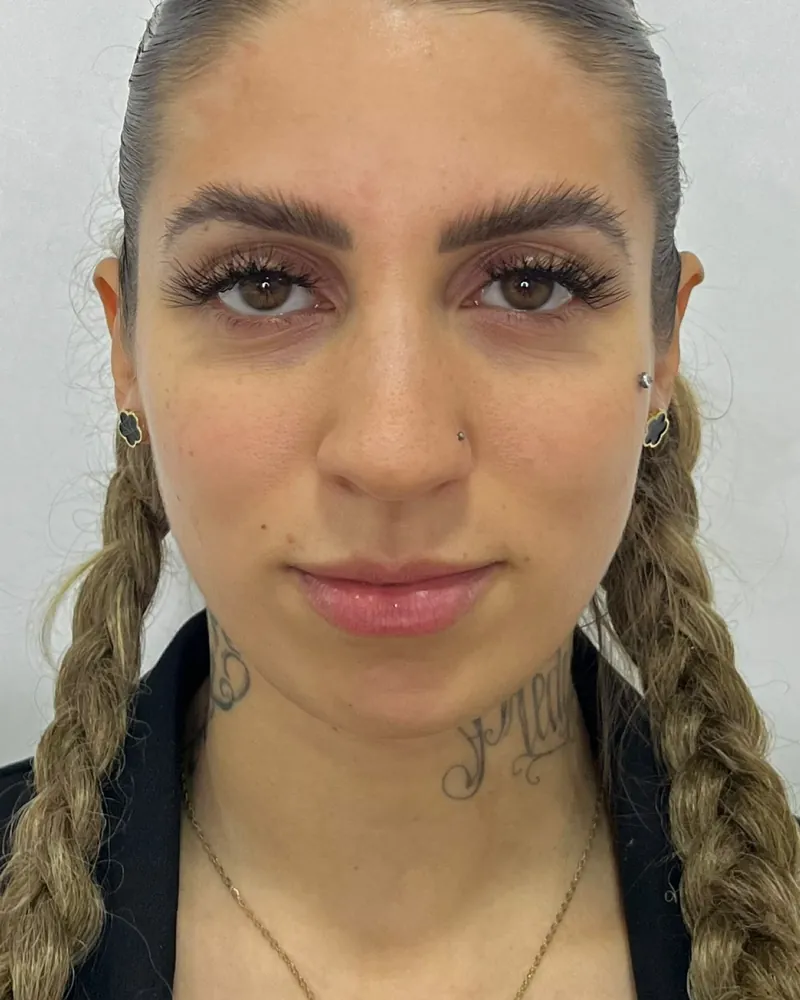Antes do contorno de mandíbula e mento, caso 1, vista frontal — paciente da biomédica Jessica Boza em Curitiba