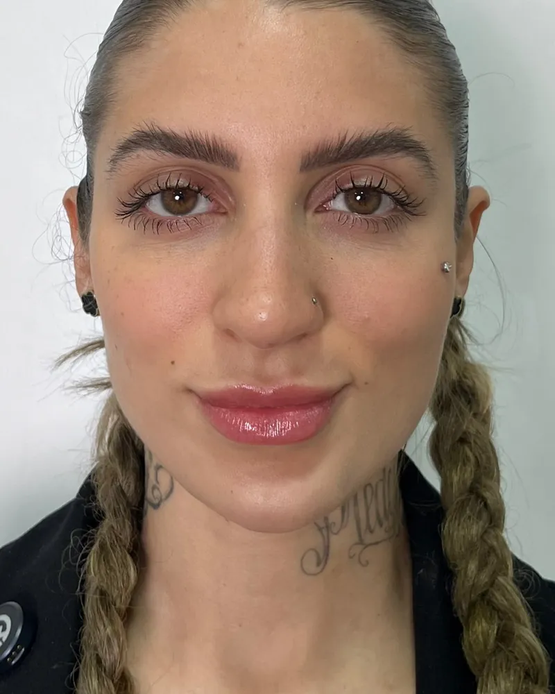 Depois do contorno de mandíbula e mento, caso 1, vista frontal — paciente da biomédica Jessica Boza em Curitiba