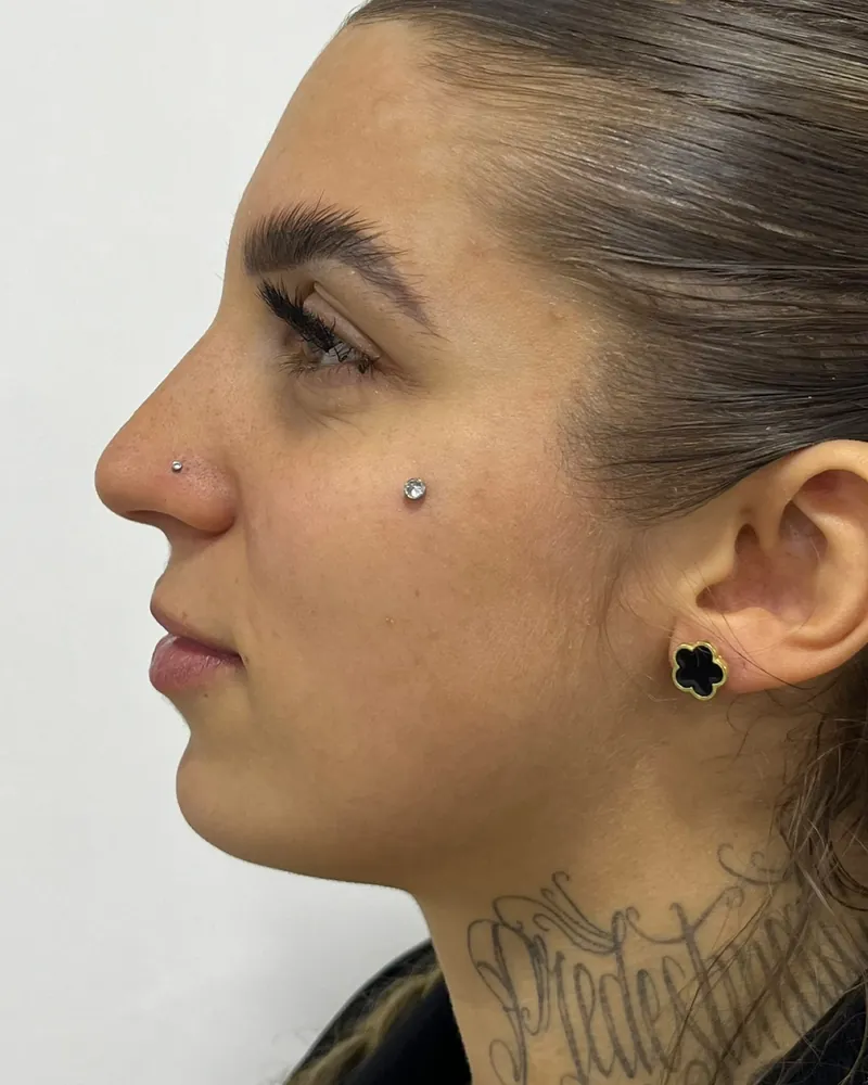 Antes do contorno de mandíbula e mento, caso 1, vista de perfil — paciente da biomédica Jessica Boza em Curitiba