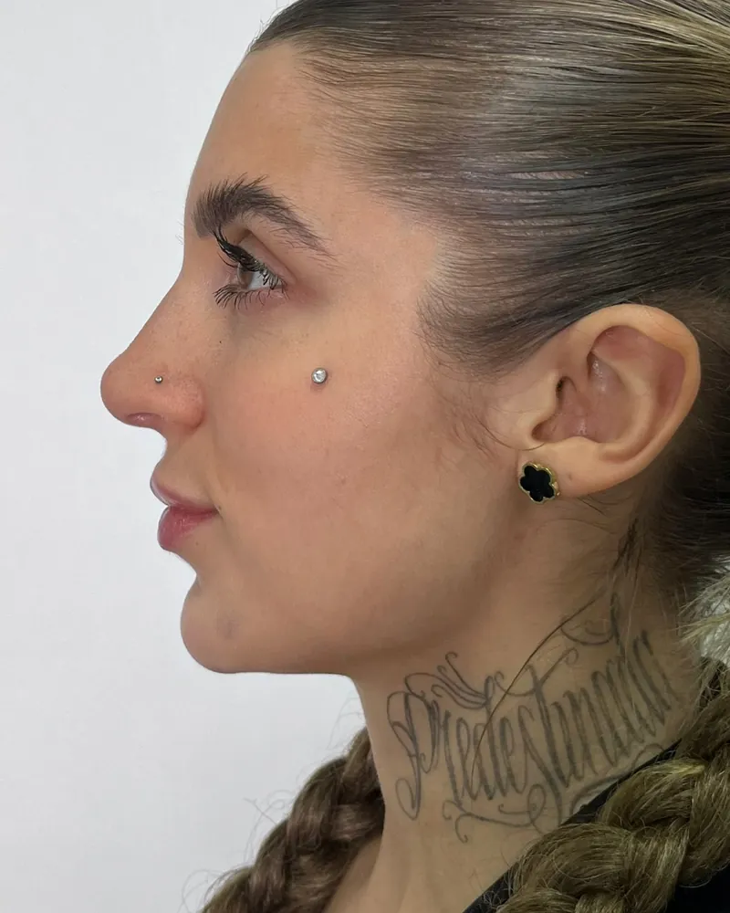 Depois do contorno de mandíbula e mento, caso 1, vista de perfil — paciente da biomédica Jessica Boza em Curitiba
