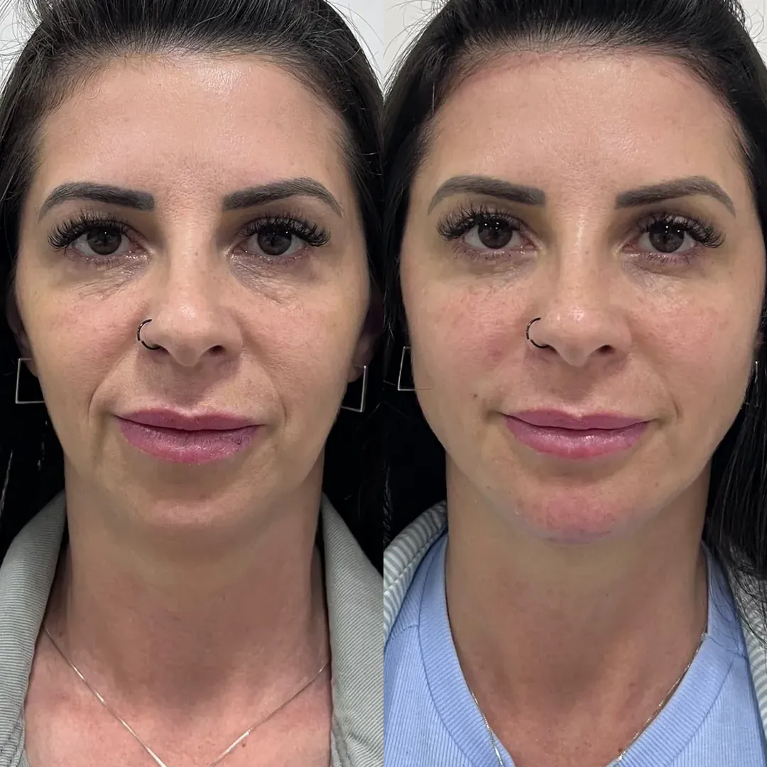 Antes e depois da harmonização facial full face — paciente da biomédica Jessica Boza em Curitiba