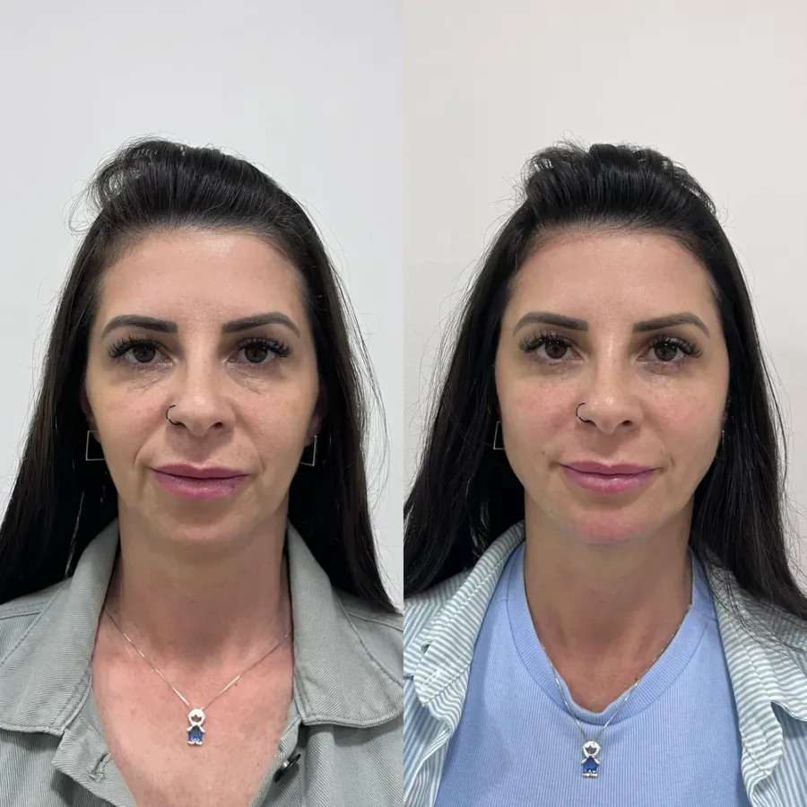 Antes e depois de harmonização facial full face, vista frontal — paciente da biomédica Jessica Boza em Curitiba