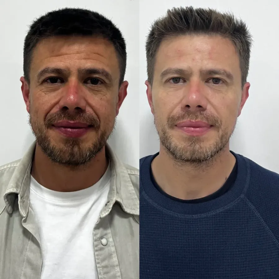 Antes e depois de harmonização facial masculina, vista frontal — paciente da biomédica Jessica Boza em Curitiba