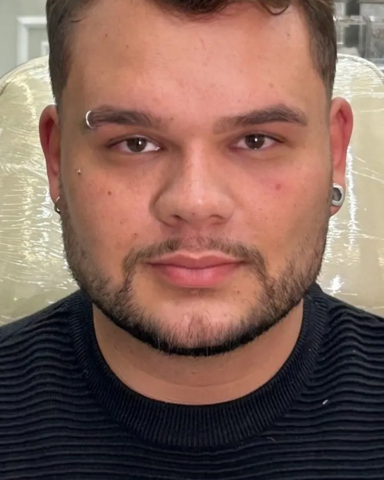 Depois da harmonização facial masculina, caso 1, vista frontal — paciente da biomédica Jessica Boza em Curitiba