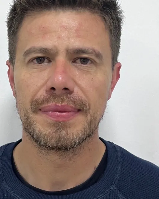 Depois da harmonização facial masculina, caso 2, vista frontal — paciente da biomédica Jessica Boza em Curitiba