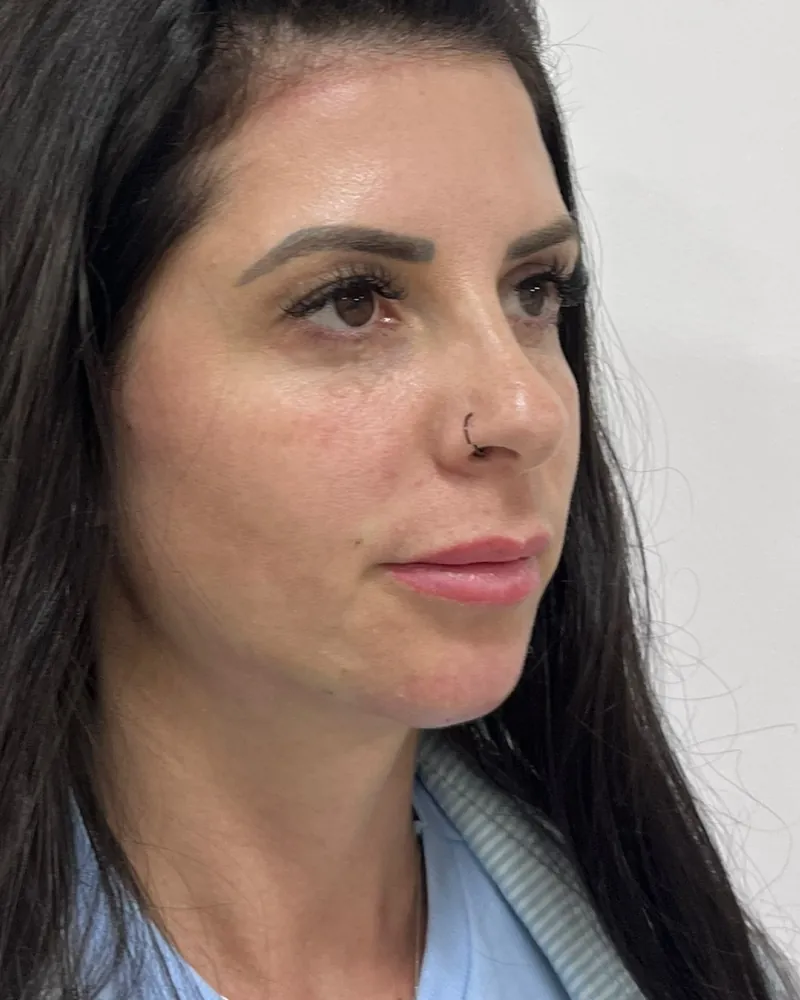 Depois da harmonização facial full face, caso 1, vista a 45 graus, outro lado — paciente da biomédica Jessica Boza em Curitiba