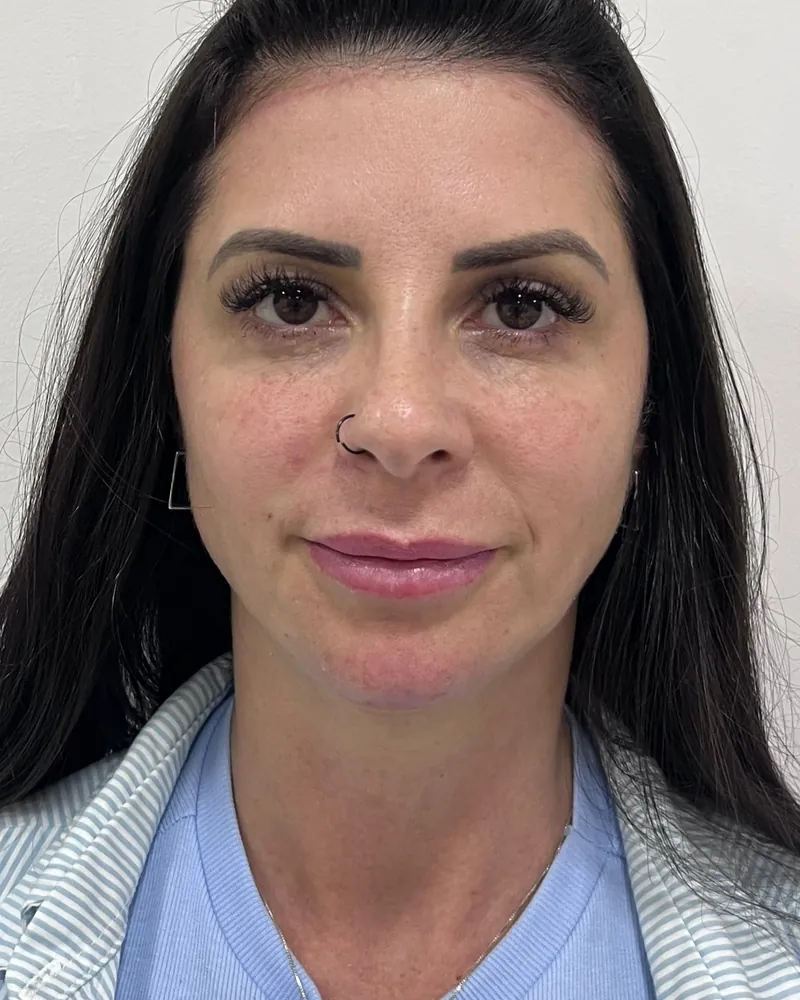 Depois da harmonização facial full face, caso 1, vista frontal — paciente da biomédica Jessica Boza em Curitiba
