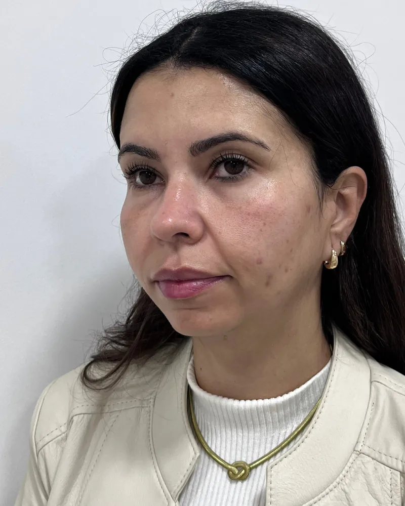 Antes da harmonização facial full face, caso 2, vista a 45 graus — paciente da biomédica Jessica Boza em Curitiba