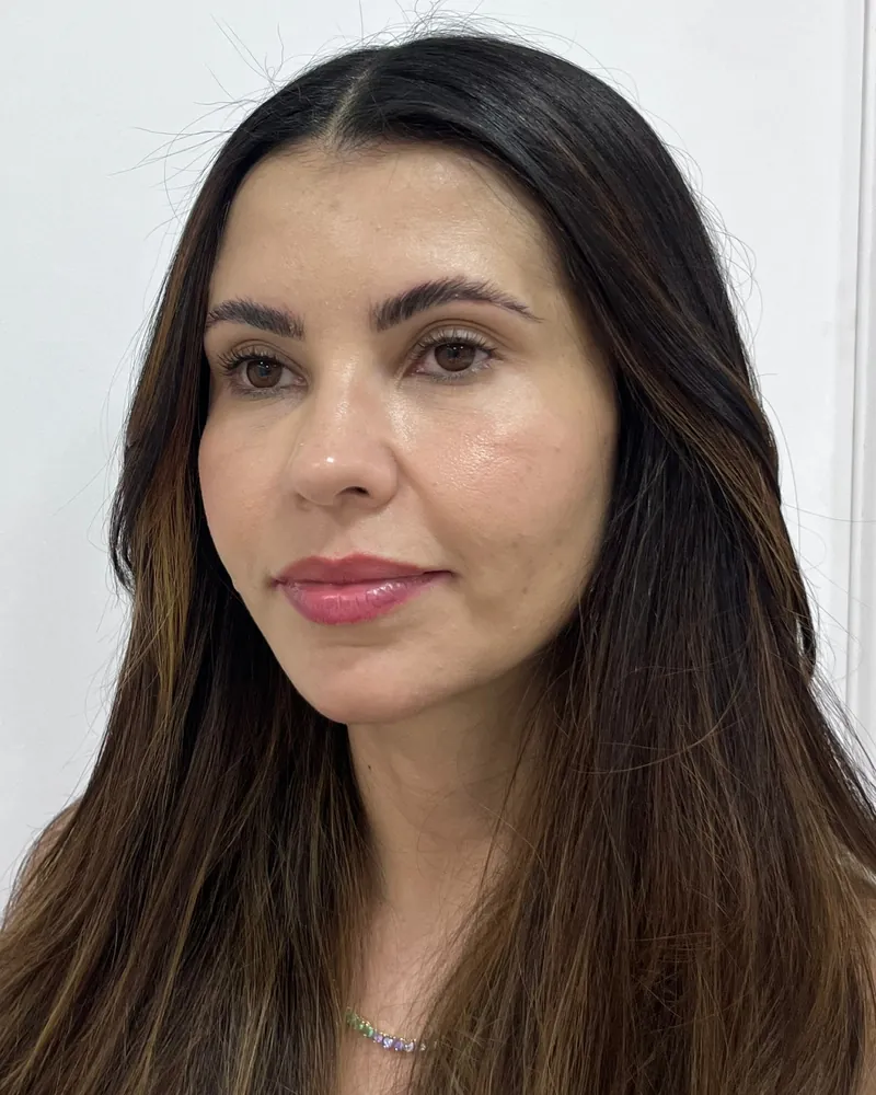 Depois da harmonização facial full face, caso 2, vista a 45 graus — paciente da biomédica Jessica Boza em Curitiba