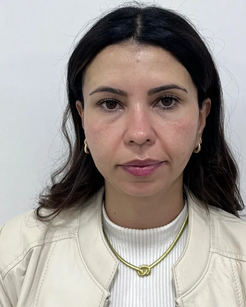Antes da harmonização facial full face, caso 2, vista frontal — paciente da biomédica Jessica Boza em Curitiba