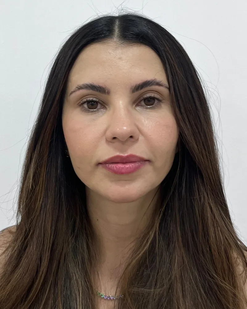 Depois da harmonização facial full face, caso 2, vista frontal — paciente da biomédica Jessica Boza em Curitiba