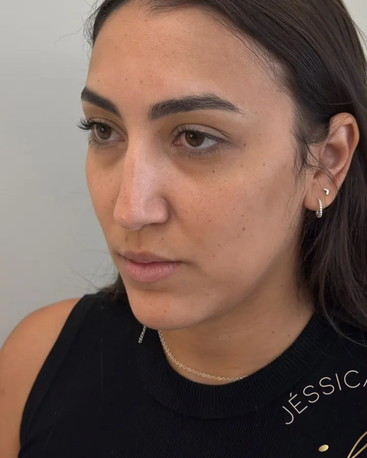 Antes da harmonização facial full face, caso 4, vista a 45 graus — paciente da biomédica Jessica Boza em Curitiba