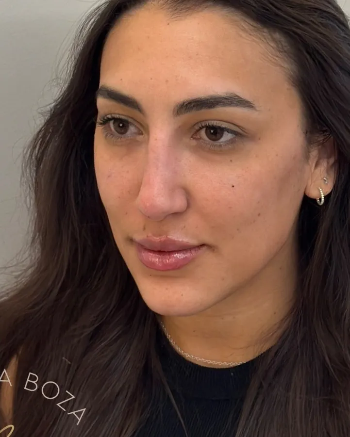Depois da harmonização facial full face, caso 4, vista a 45 graus — paciente da biomédica Jessica Boza em Curitiba