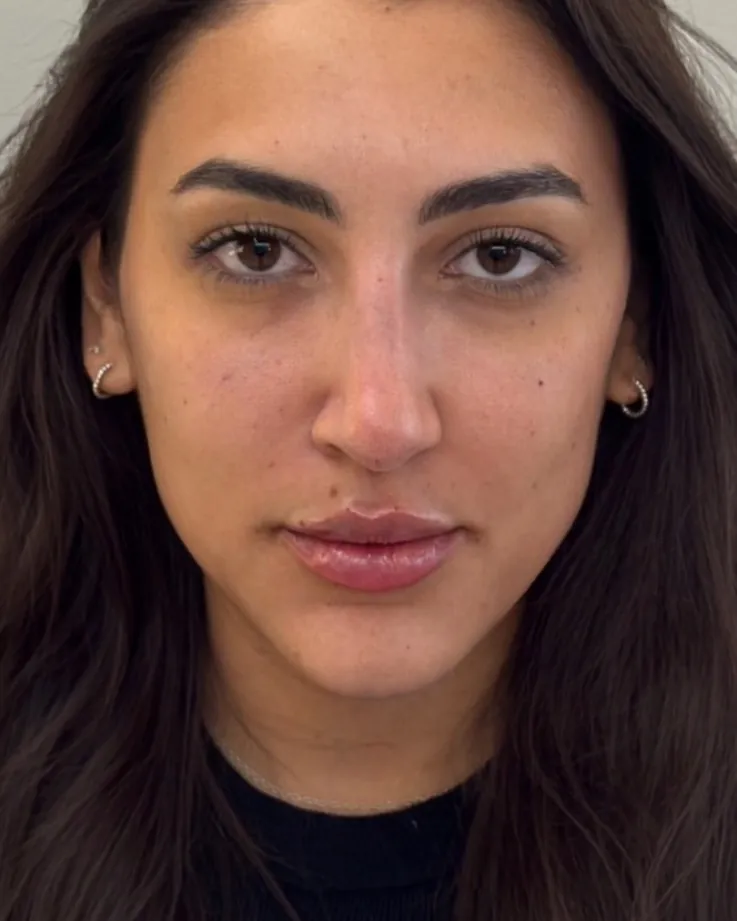 Depois da harmonização facial full face, caso 4, vista frontal — paciente da biomédica Jessica Boza em Curitiba