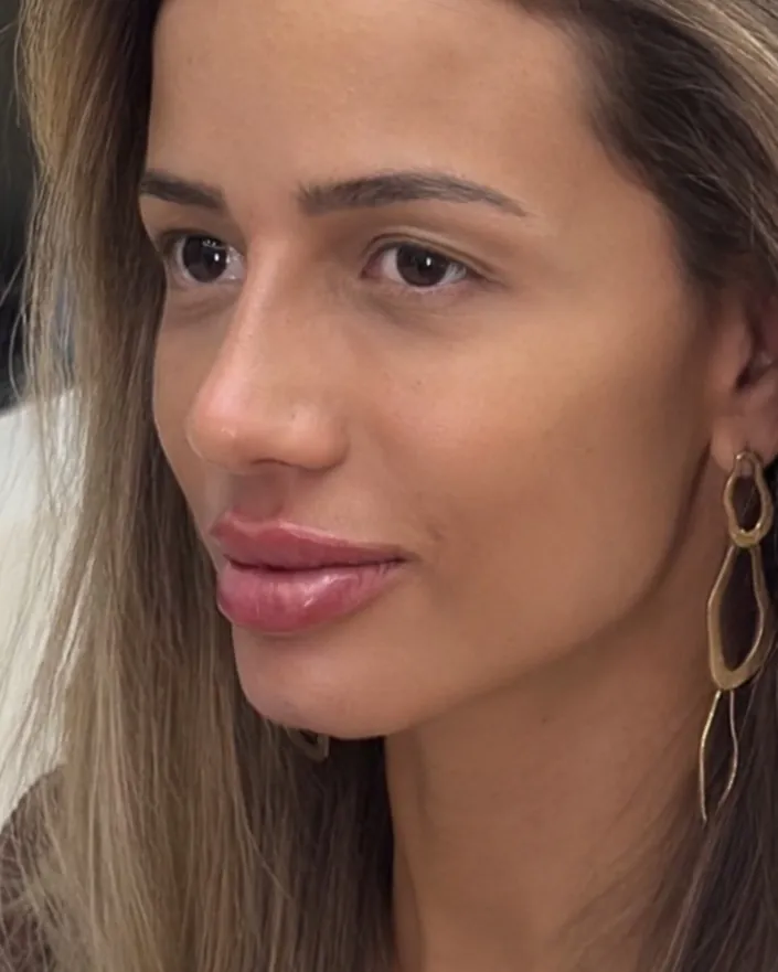 Depois da harmonização facial full face, caso 5, vista a 45 graus — paciente da biomédica Jessica Boza em Curitiba