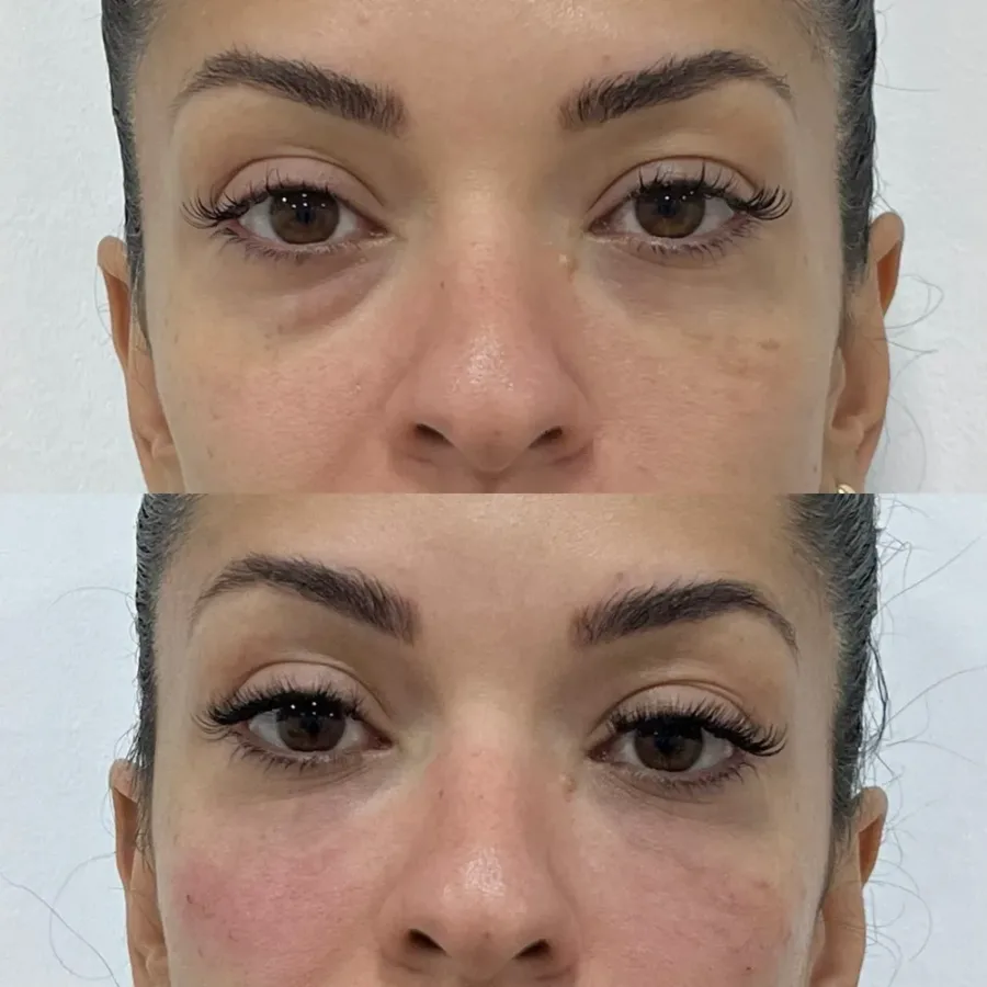 Antes (em cima) e depois (embaixo) de preenchimento de olheiras — paciente da biomédica Jessica Boza em Curitiba