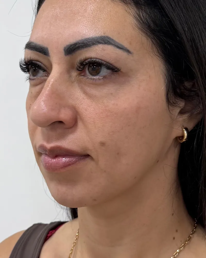 Antes do preenchimento de olheiras, caso 1, vista a 45 graus, outro lado — paciente da biomédica Jessica Boza em Curitiba