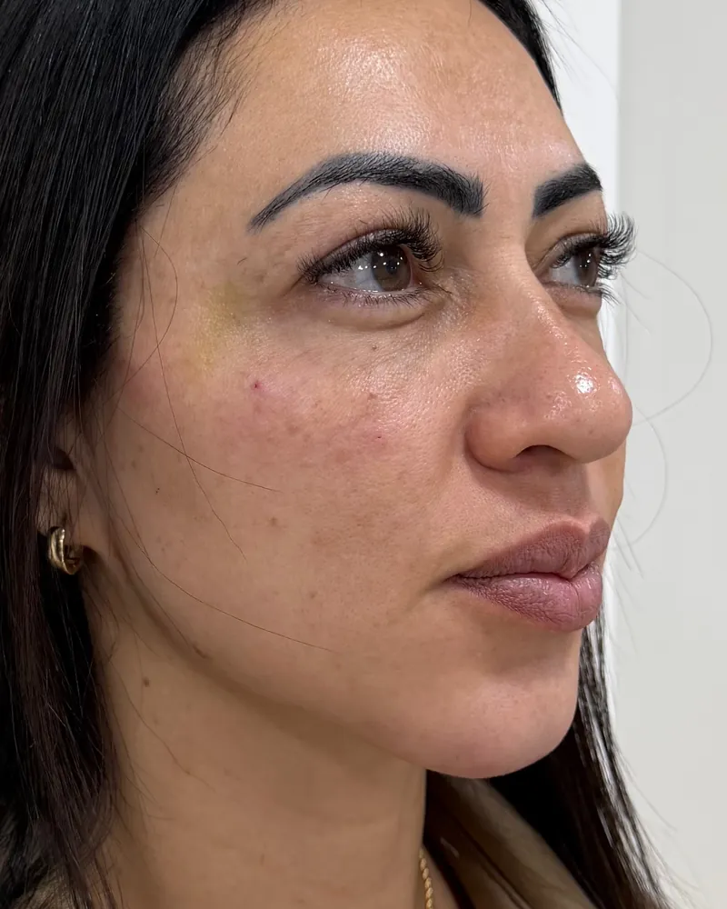Depois do preenchimento de olheiras, caso 1, vista a 45 graus — paciente da biomédica Jessica Boza em Curitiba