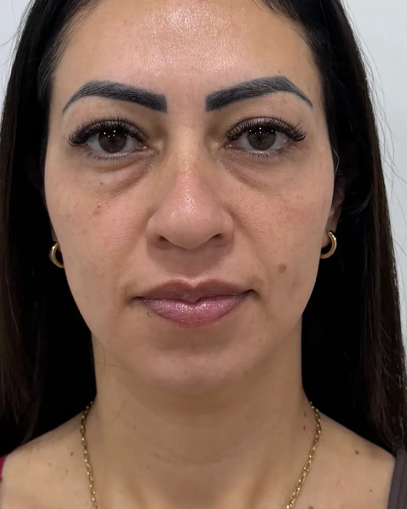 Antes do preenchimento de olheiras, caso 1, vista frontal — paciente da biomédica Jessica Boza em Curitiba