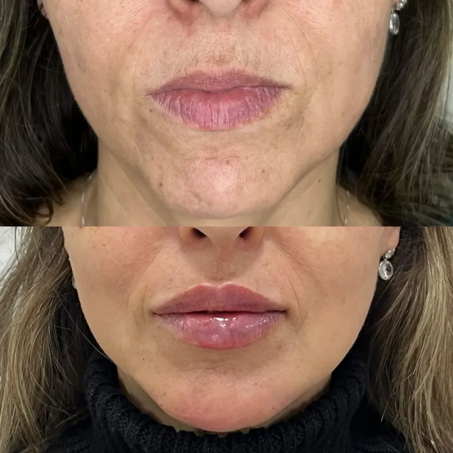 Antes (em cima) e depois (embaixo) de preenchimento labial — paciente da biomédica Jessica Boza em Curitiba