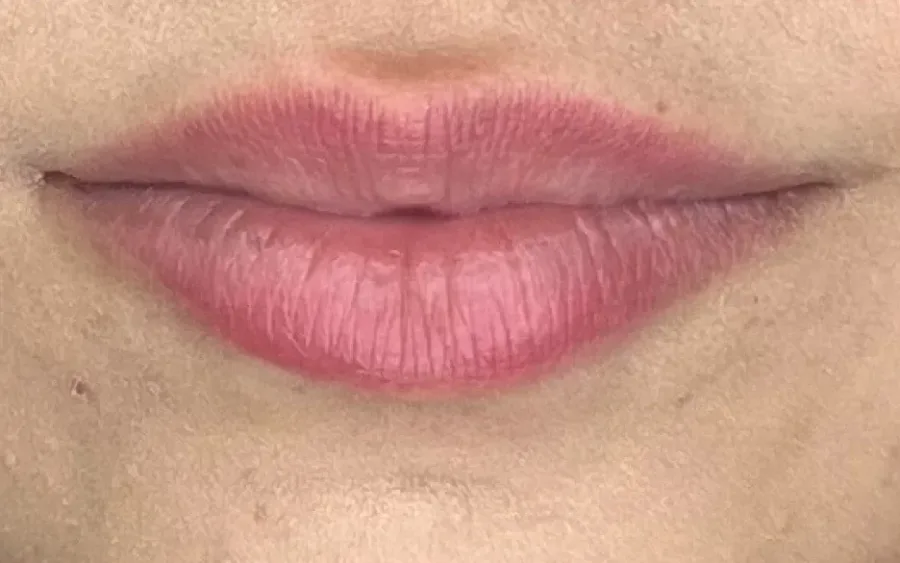 Antes do preenchimento labial, caso 1 — paciente da biomédica Jessica Boza em Curitiba