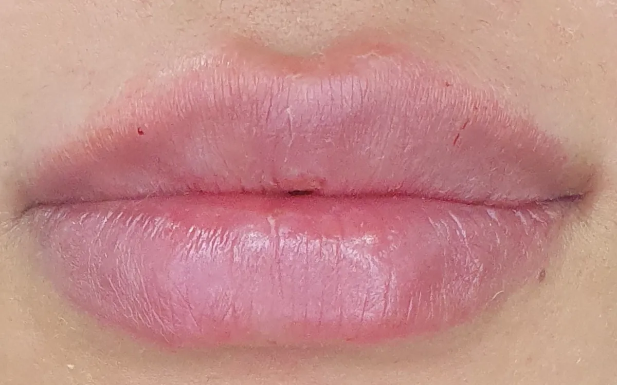 Depois do preenchimento labial, caso 2 — paciente da biomédica Jessica Boza em Curitiba