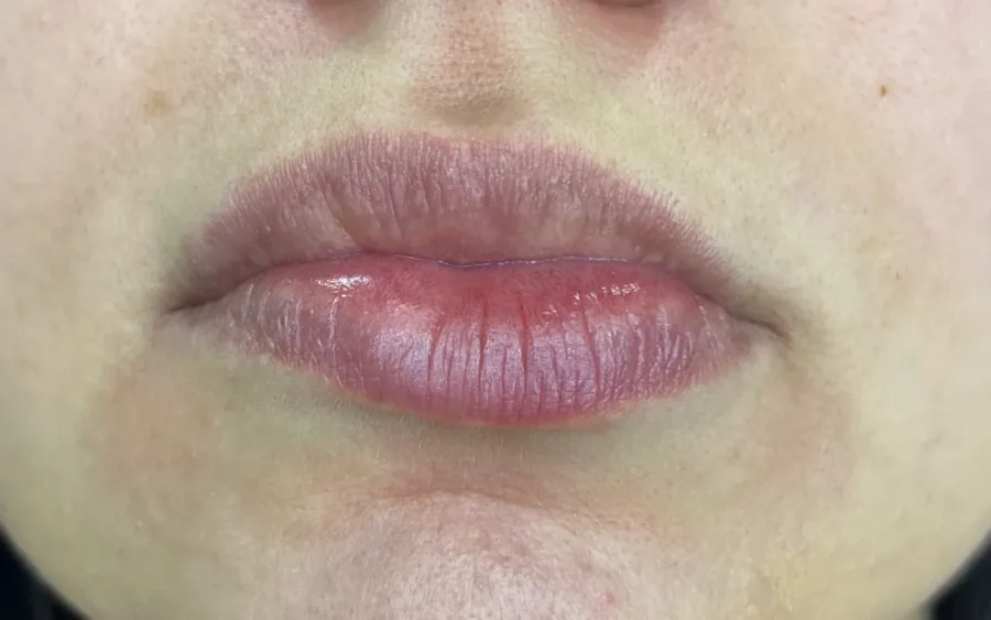 Antes do preenchimento labial, caso 3 — paciente da biomédica Jessica Boza em Curitiba