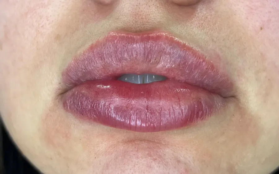 Depois do preenchimento labial, caso 3 — paciente da biomédica Jessica Boza em Curitiba