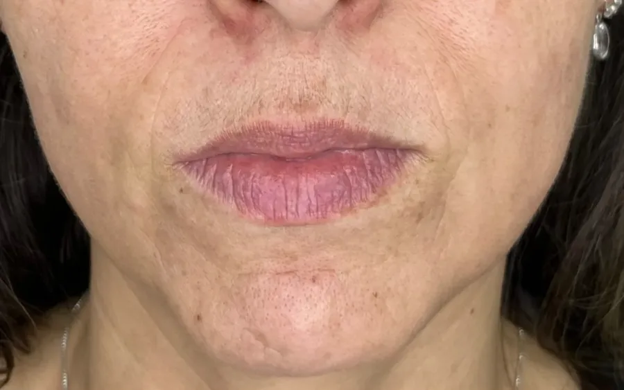 Antes do preenchimento labial, caso 4 — paciente da biomédica Jessica Boza em Curitiba