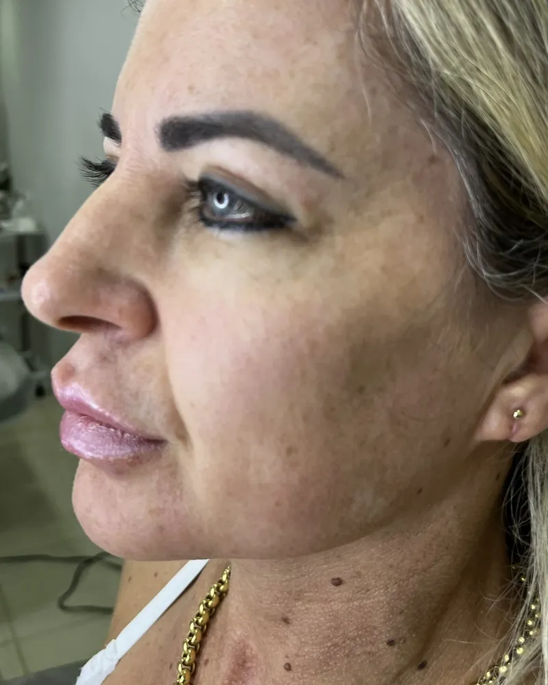 Antes do rejuvenescimento facial, caso 1, vista a 45 graus — paciente da biomédica Jessica Boza em Curitiba