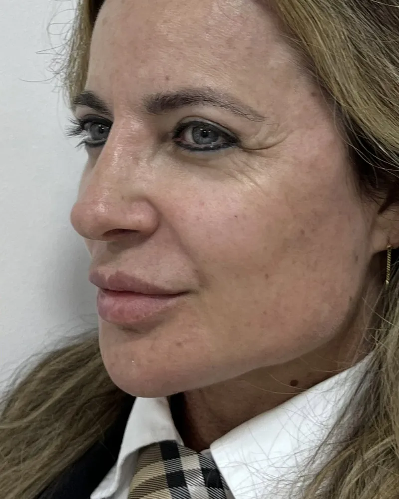 Depois do rejuvenescimento facial, caso 1, vista a 45 graus — paciente da biomédica Jessica Boza em Curitiba