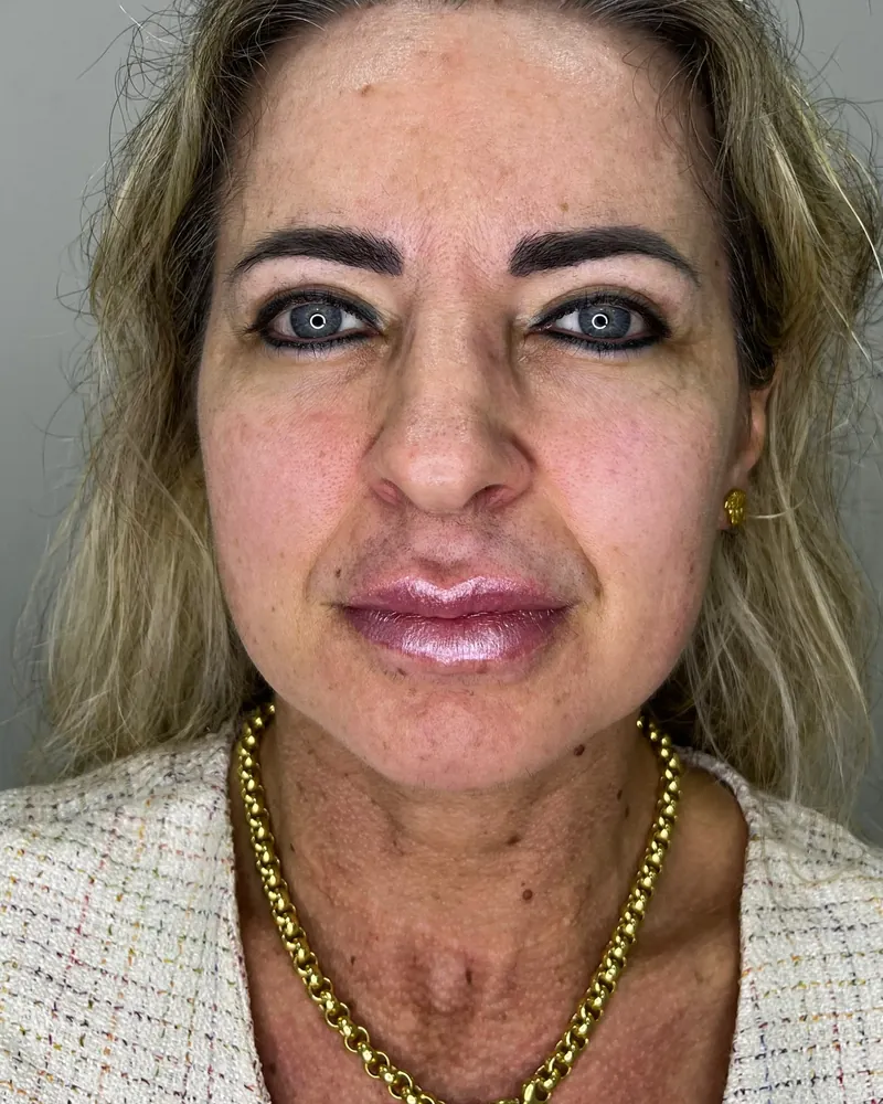 Antes do rejuvenescimento facial, caso 1, vista frontal — paciente da biomédica Jessica Boza em Curitiba