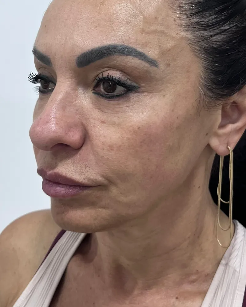 Antes do rejuvenescimento facial, caso 2, vista a 45 graus — paciente da biomédica Jessica Boza em Curitiba