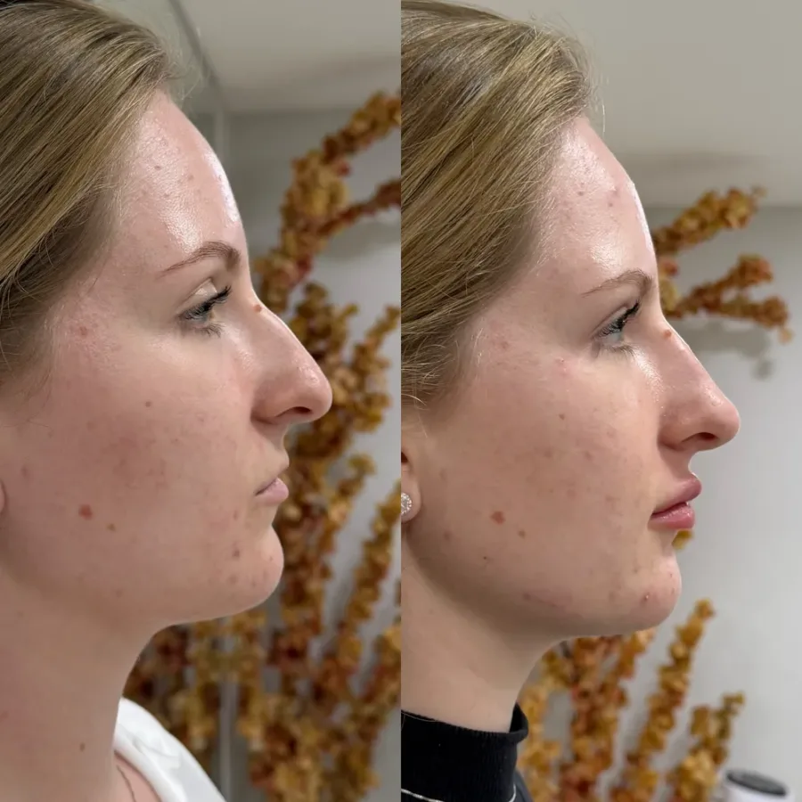 Antes e depois de rinomodelação, vista de perfil — paciente da biomédica Jessica Boza em Curitiba