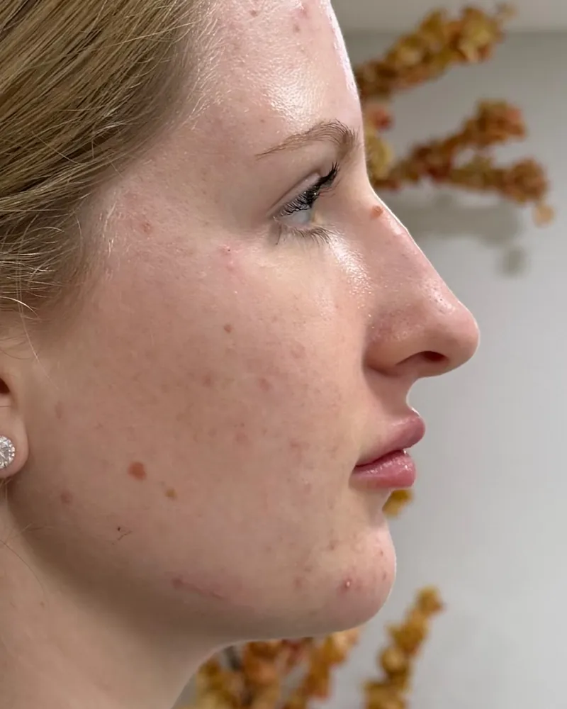 Depois da rinomodelação, caso 2, vista de perfil — paciente da biomédica Jessica Boza em Curitiba